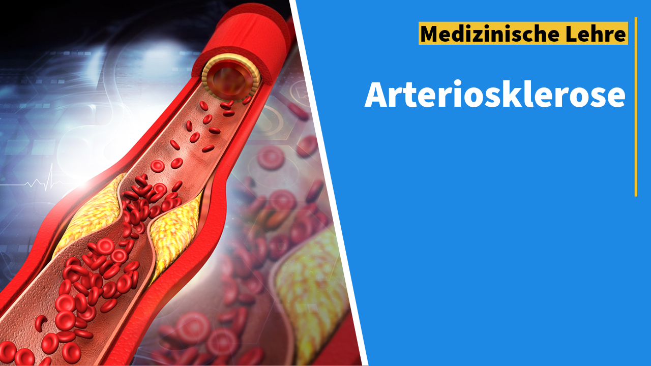 Illustration einer verengten Arterie, die durch arteriosklerotische Plaques blockiert ist, mit roten Blutkörperchen im Inneren. Auf der rechten Seite des Bildes steht der Text "Medizinische Lehre Arteriosklerose" vor einem blauen Hintergrund, zusammen mit den Begriffen "Atherosklerose", "Mönckeberg-Sklerose" und "Arteriolosklerose".