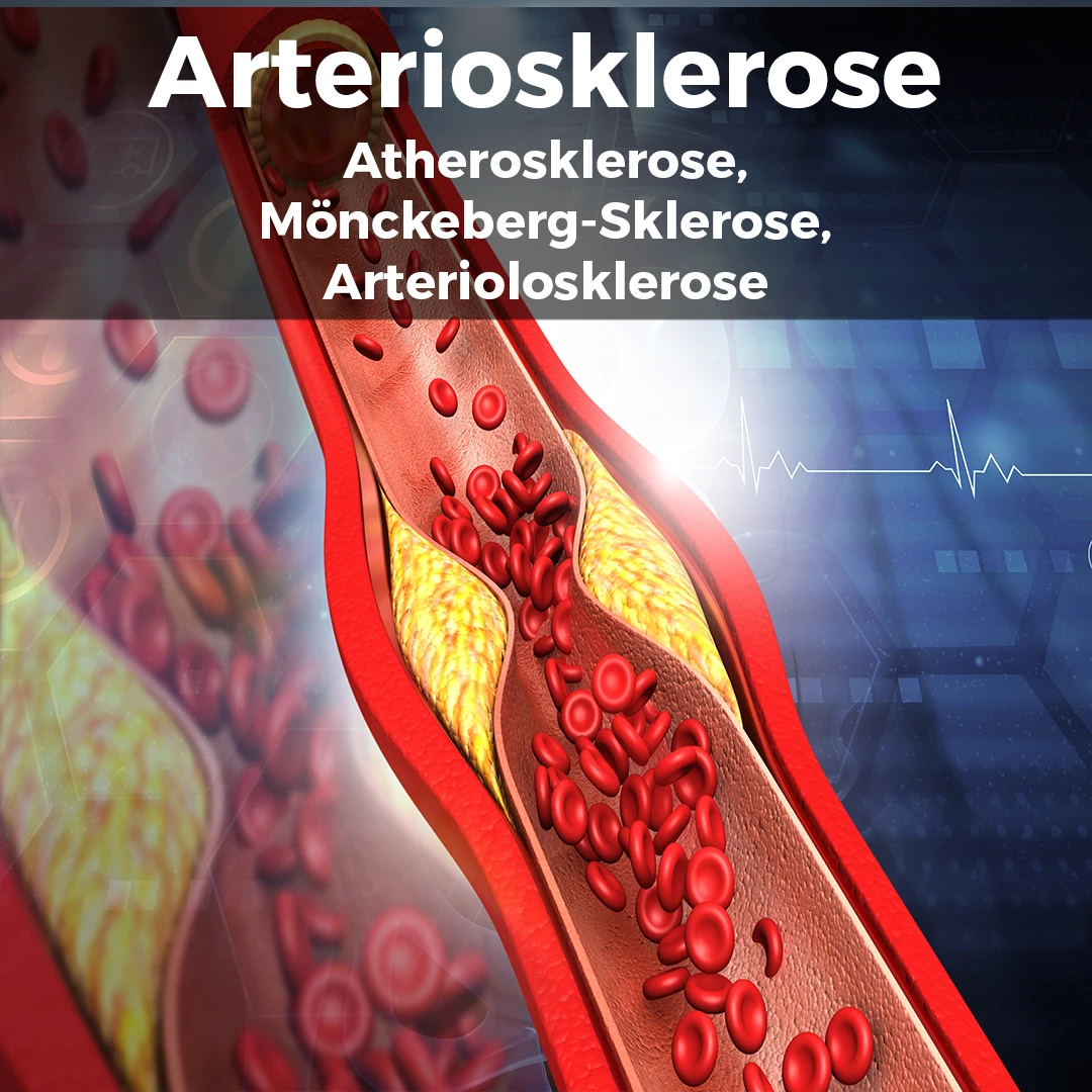 Illustration einer verengten Arterie, die durch arteriosklerotische Plaques blockiert ist, mit roten Blutkörperchen im Inneren. Auf der rechten Seite des Bildes steht der Text "Medizinische Lehre Arteriosklerose" vor einem blauen Hintergrund, zusammen mit den Begriffen "Atherosklerose", "Mönckeberg-Sklerose" und "Arteriolosklerose".