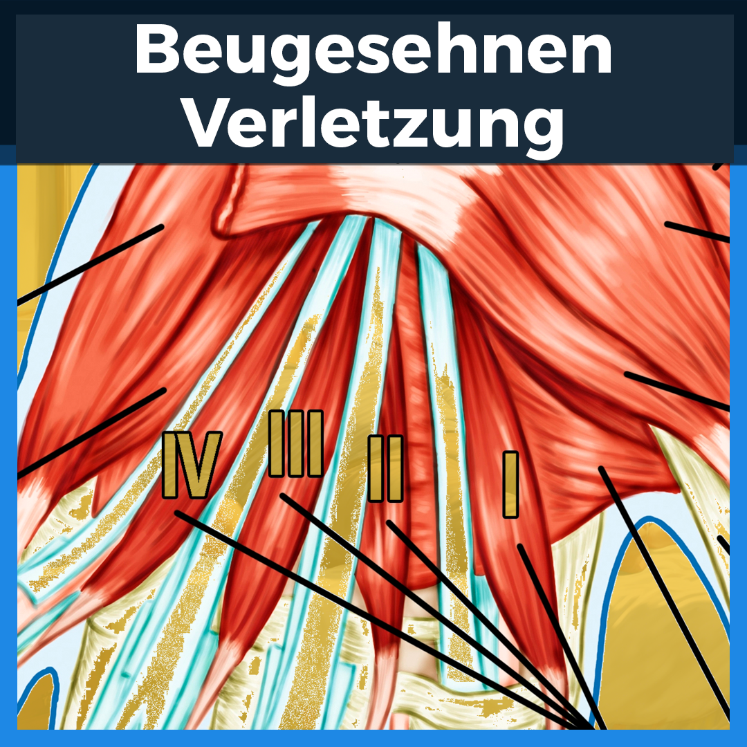 Medizinische Illustration der Beugesehnen mit nummerierten Markierungen für therapeutische und diagnostische Zwecke
