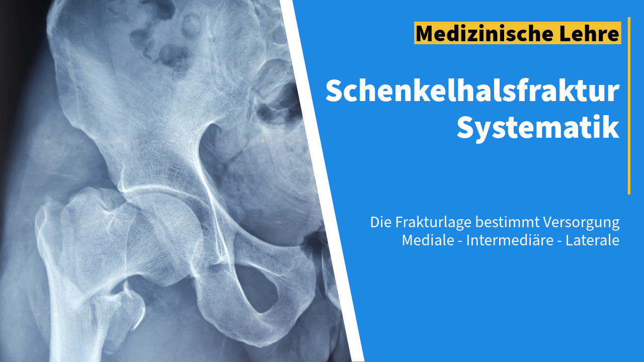 Röntgenbild einer Hüftfraktur mit gebrochenem und disloziertem Oberschenkelhals