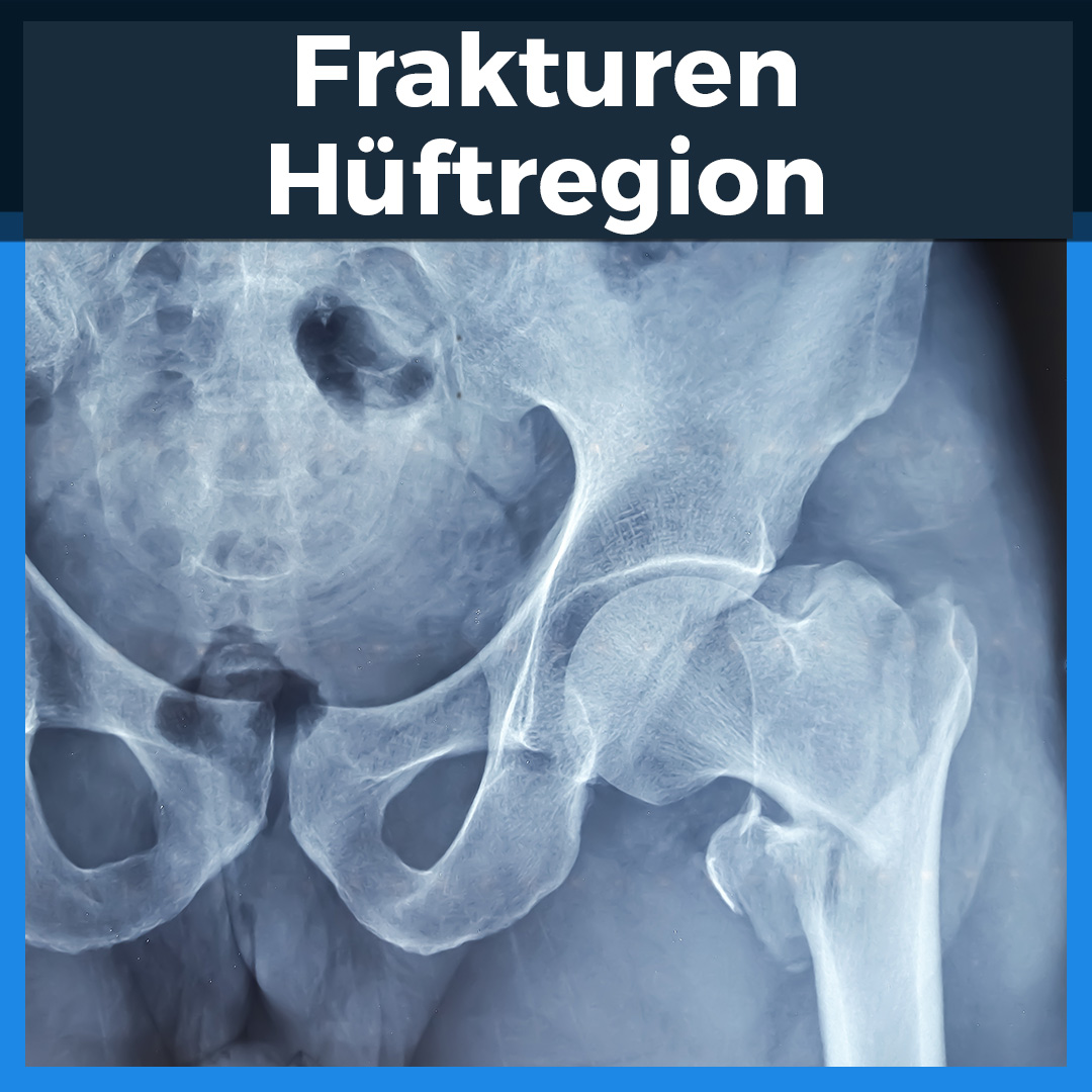 Röntgenbild einer Hüftfraktur mit gebrochenem und disloziertem Oberschenkelhals