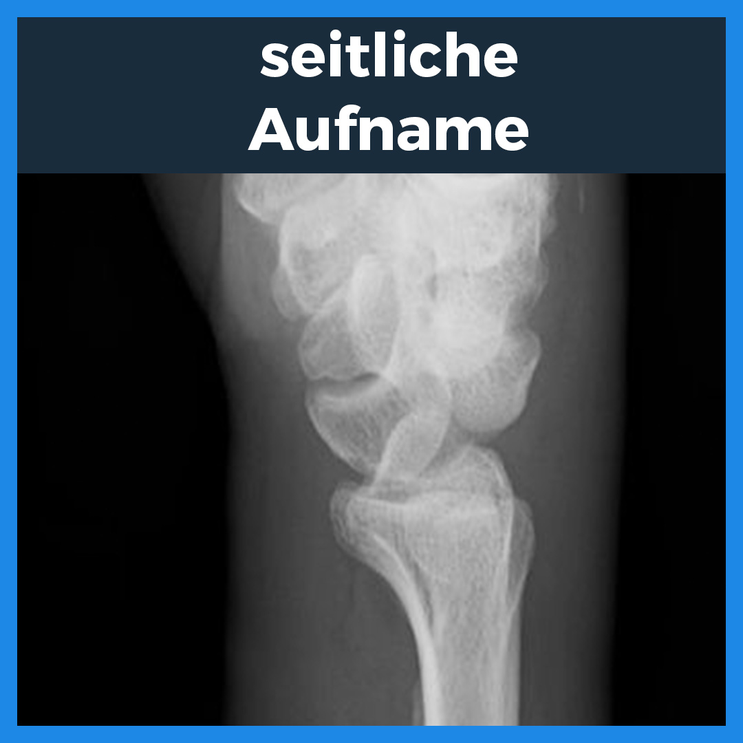 Röntgenaufnahmen einer perilunaren Luxation des rechten Handgelenks in dorsopalmarer und seitlicher Ansicht. Die Bilder zeigen eine Fehlstellung des Lunatums mit markierten Bereichen zur besseren Visualisierung der Dislokation. Zusätzlich eine Texttafel mit Fallbeschreibung eines 74-jährigen Patienten, der mit Schmerzen und Schwellungen nach einem Sturz vorgestellt wurde.